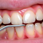 Arthritis & Rheumatology |10分文章带你揭秘微生物组学研究口腔微生物与类风湿关节炎之间的联系