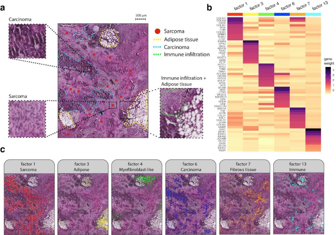 FFPE空间转录组解析卵巢癌肉瘤免疫浸润过程[4]