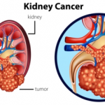 单细胞测序在肾透明细胞癌中的应用