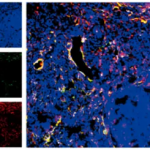 《cell reports》慢性肉芽肿病的发病机制新发现
