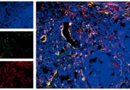 《cell reports》慢性肉芽肿病的发病机制新发现