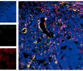 《cell reports》慢性肉芽肿病的发病机制新发现